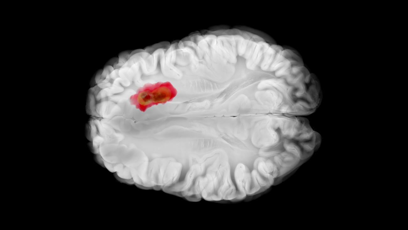 Highlight in red of a patch of glioblastoma in the brain