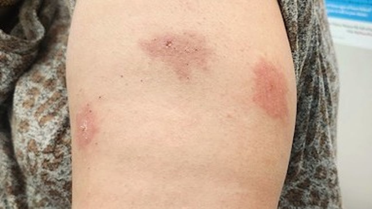 Close up of a patient's arm with a blotchy rash