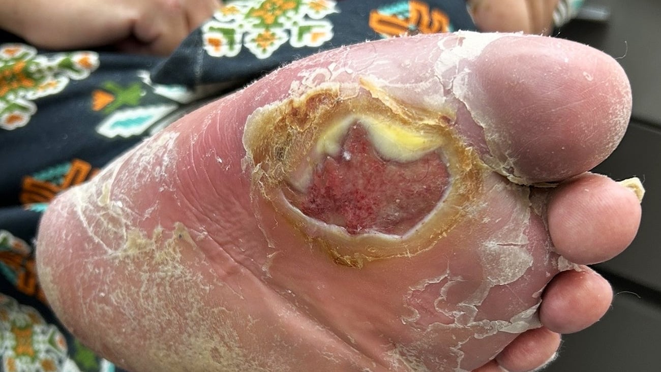 A patient with a lesion on his foot, with pus coming out.