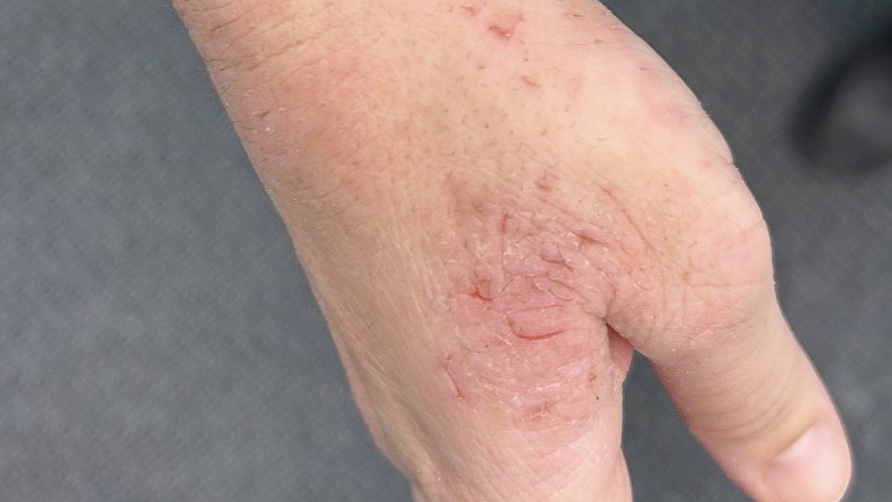 Dry, cracking, excoriated patches on the back of a patient's hand.
