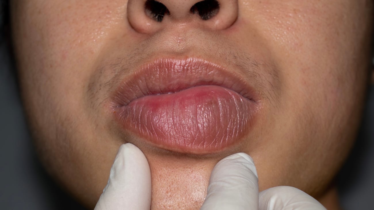 Man's swollen lip because of hereditary angioedema