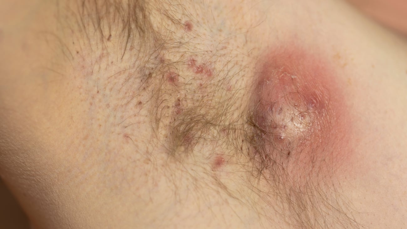 hidradenitis suppurativa under a patient's armpit