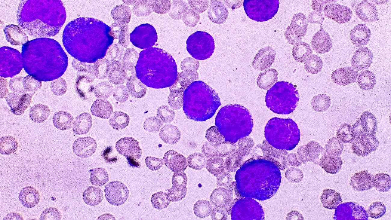 Blood cancer under a microscope