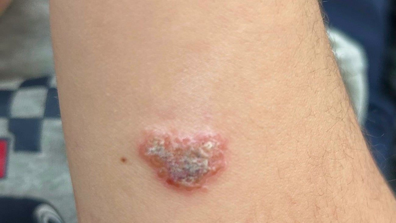A strange grey scab on a fair-skinned patient's arm