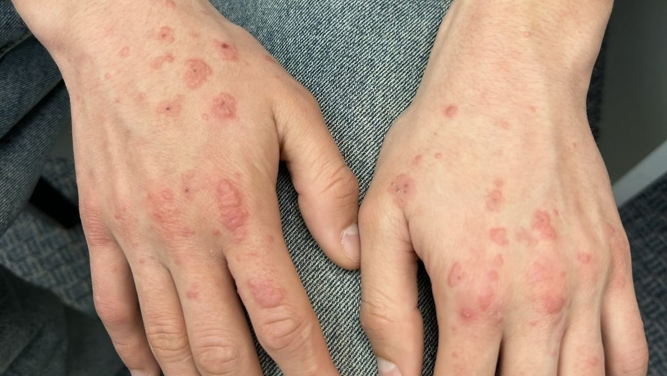 A fair-skinned man's hand with a red blotchy rash