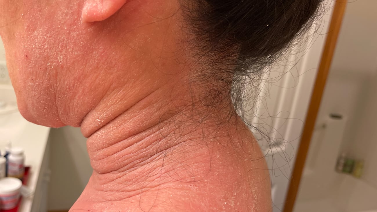 eczema, topical steroid, withdrawal on woman's neck