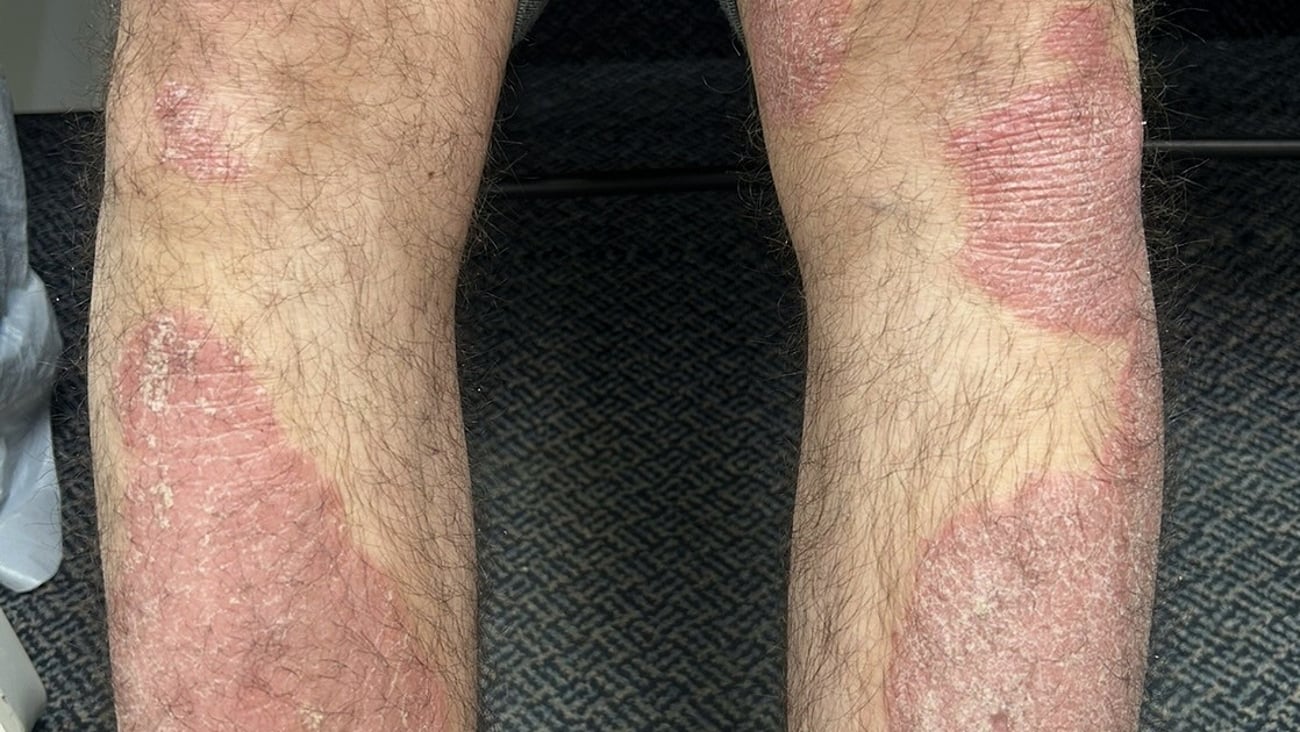 Close up a of a fair-skinned patient's legs with eczema