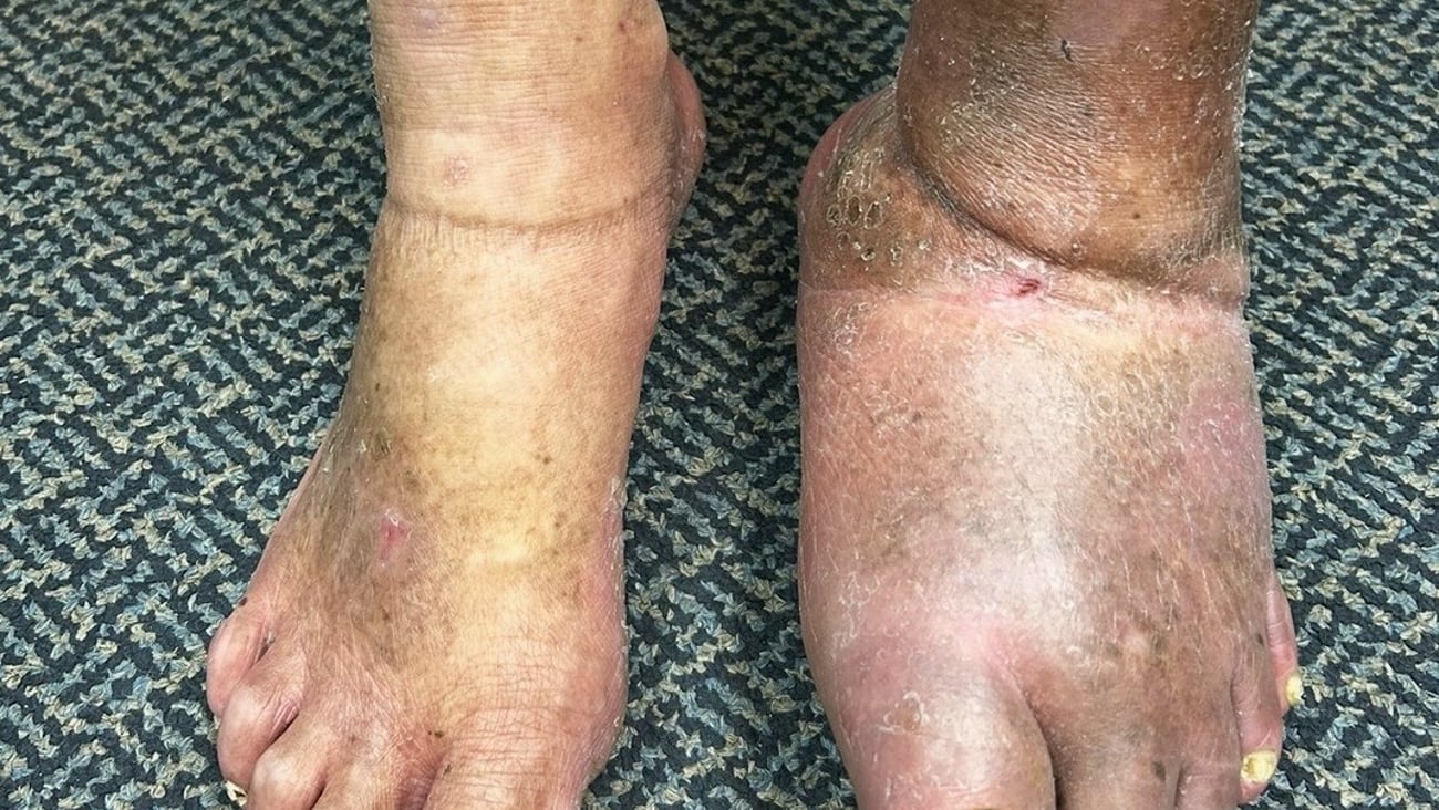 A patient's feet with one very swollen for complications of diabetes