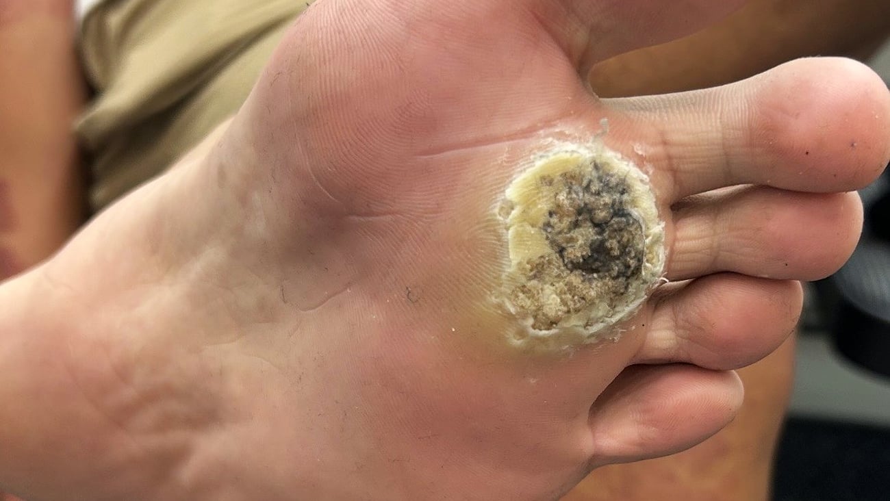 Close up of patient's foot with unusual infected blister on the bottom
