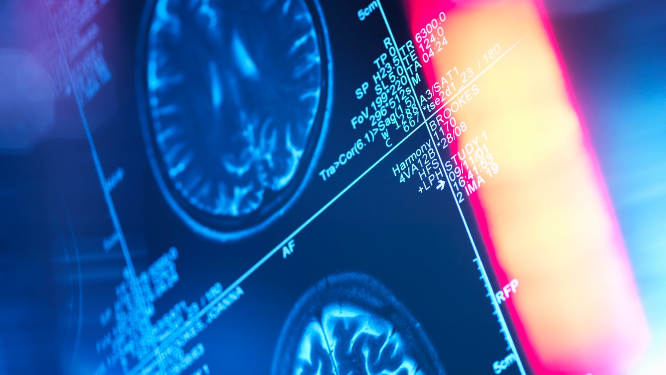 Close up of a brain scan with a red sun flare in the foreground