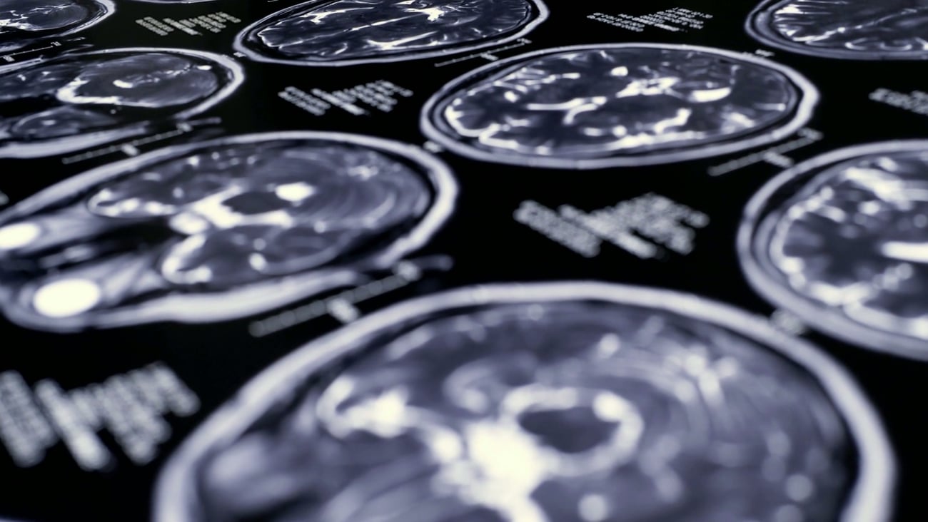 Close up of the results of an MRI brain scan 