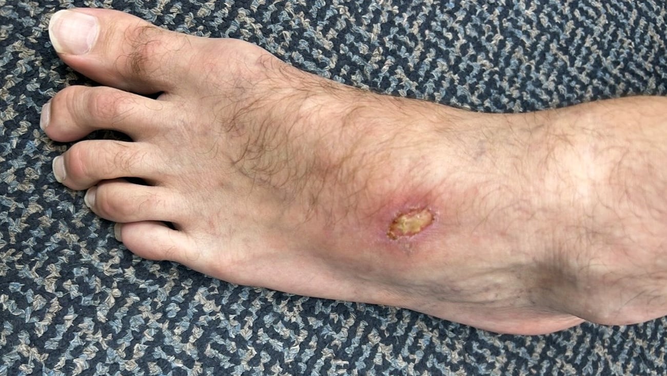 A patient's foot with a wound