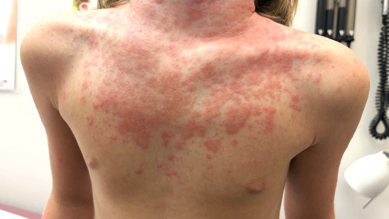 Young male patient with severe red rash on his chest