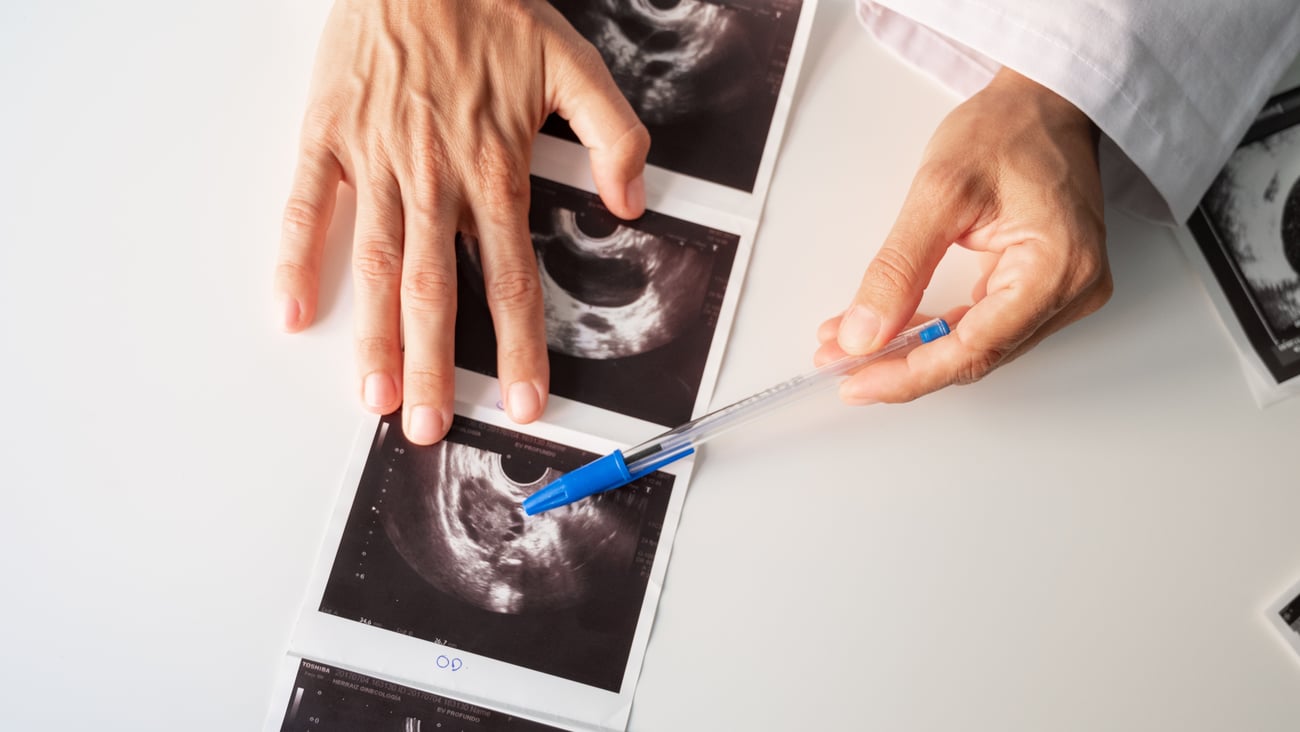 An ultrasound indicating polyendocrine metabolic ovarian syndrome