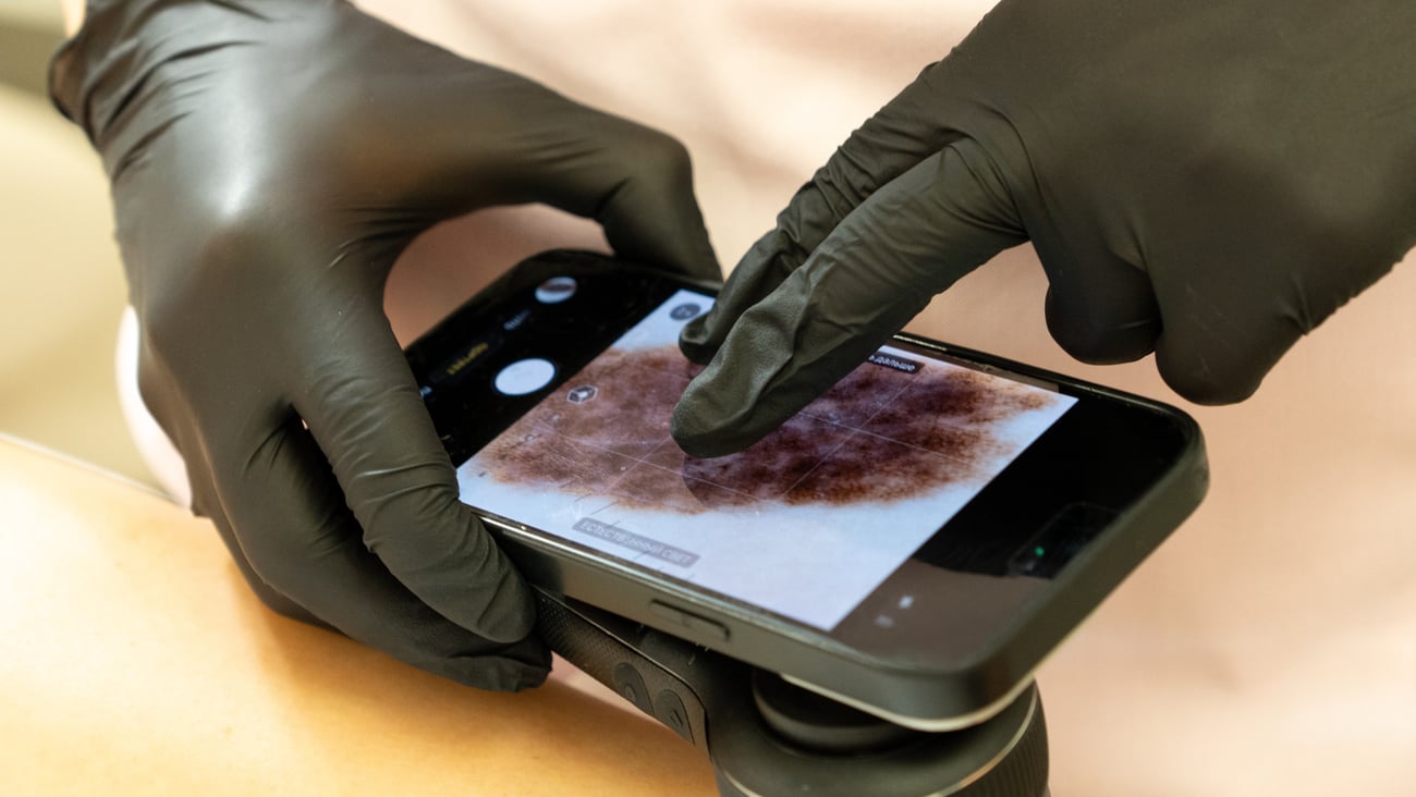 A healthcare provider examines a skin lesion with a digital dermoscopy device.