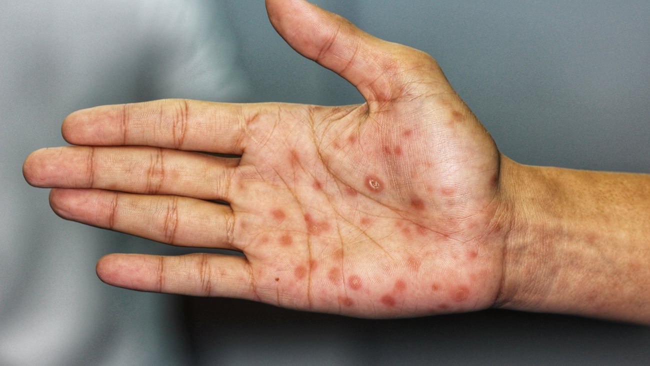 Close up of a patient's hand with syphilitic sores