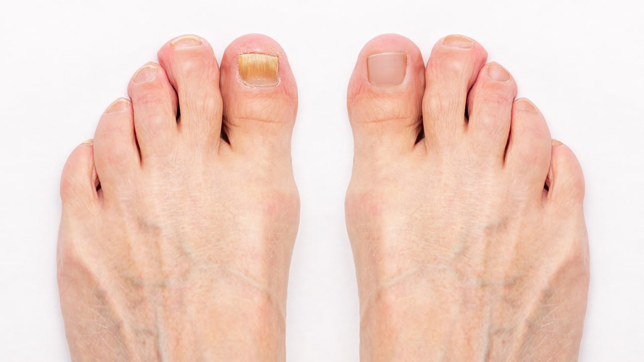Close up of a pair of feet with a fungal infection on one toe