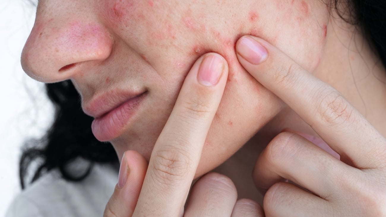 A young woman presses acne and pimples on skin on face with her fingers.