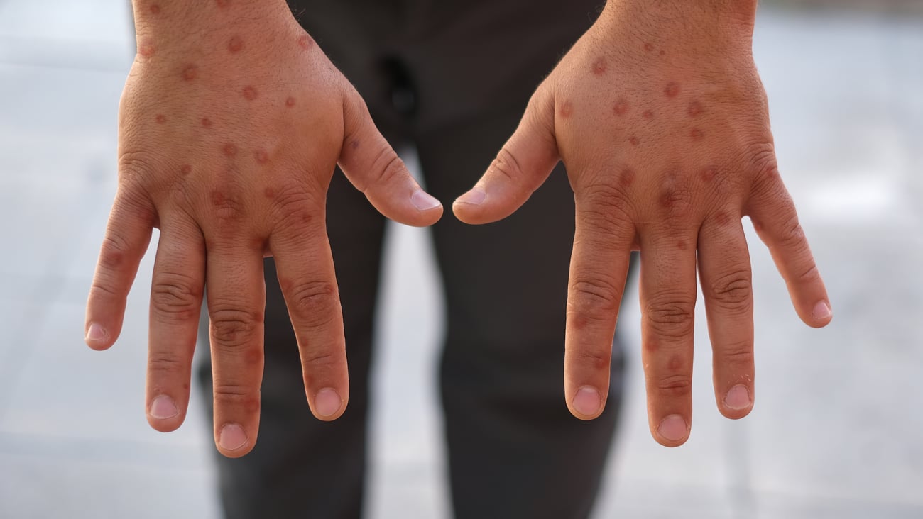 Hands showing a rash from mpox.