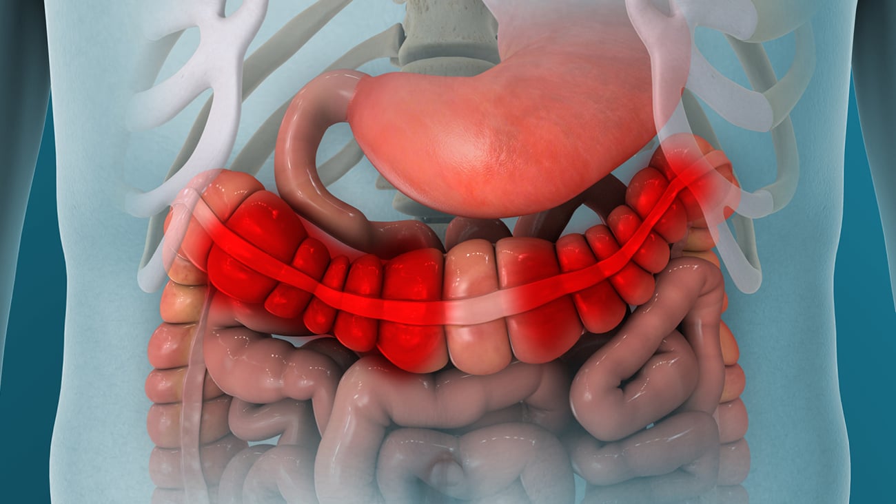 Cartoon rendering of inflamed large intestines