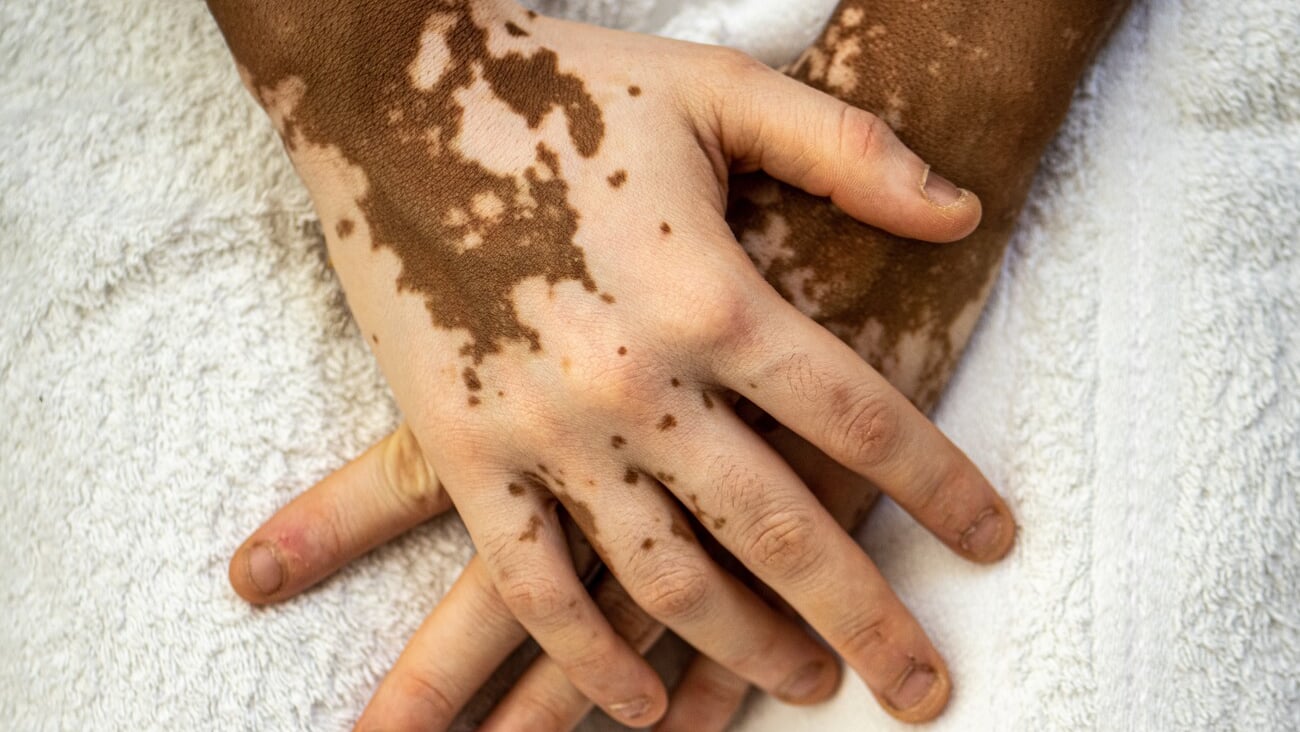 Details of skin tones on the hands of a young African woman with skin vitiligo,skin care and genetic melatonin change; Shutterstock ID 2168815693