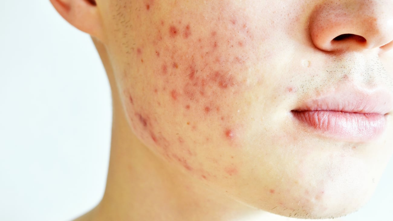 Close up of face with acne