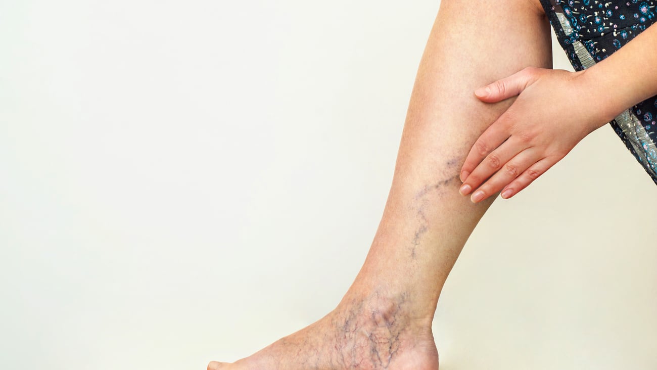 Woman touching lower leg (calf area) with hand, where there are obvious purplish veins