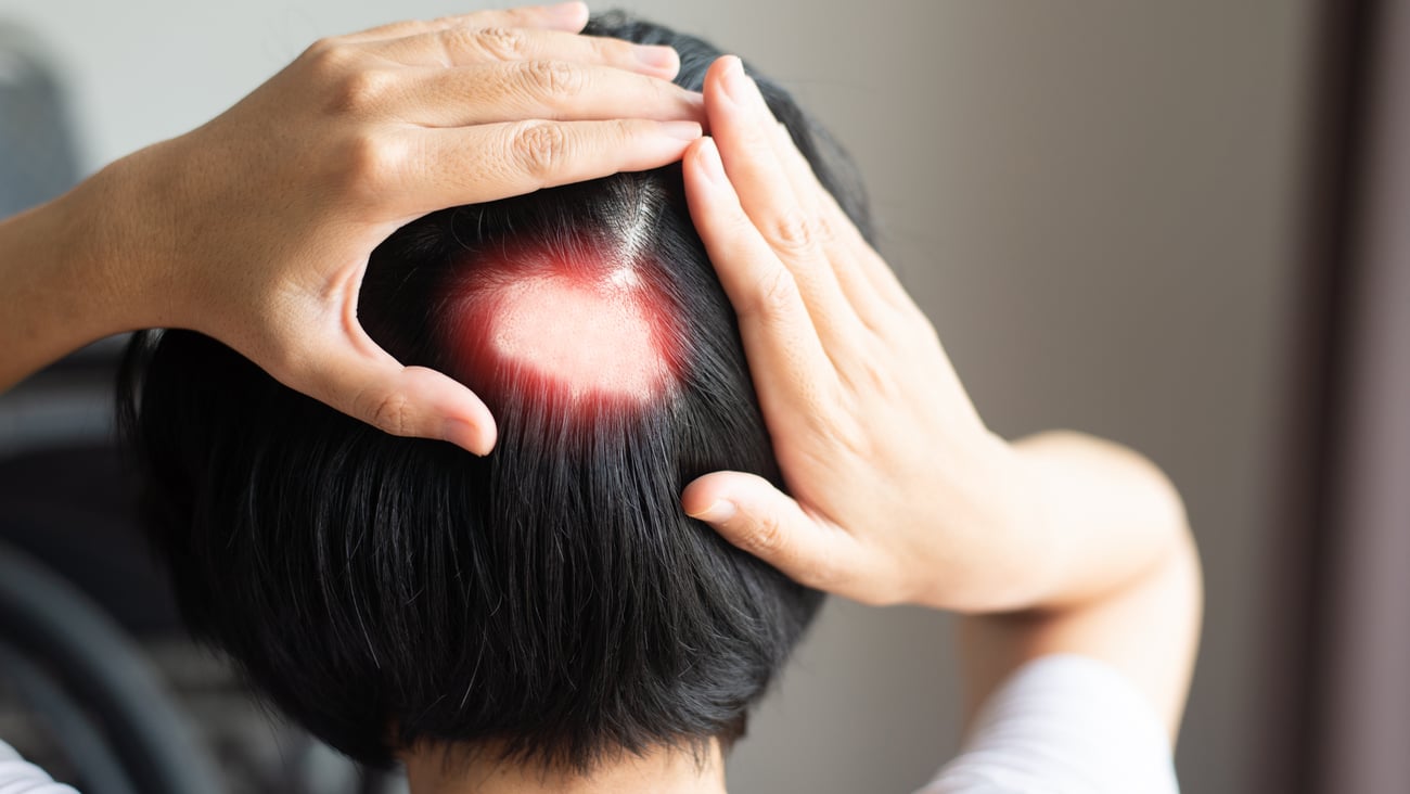 Woman with alopecia areata spot on her head 