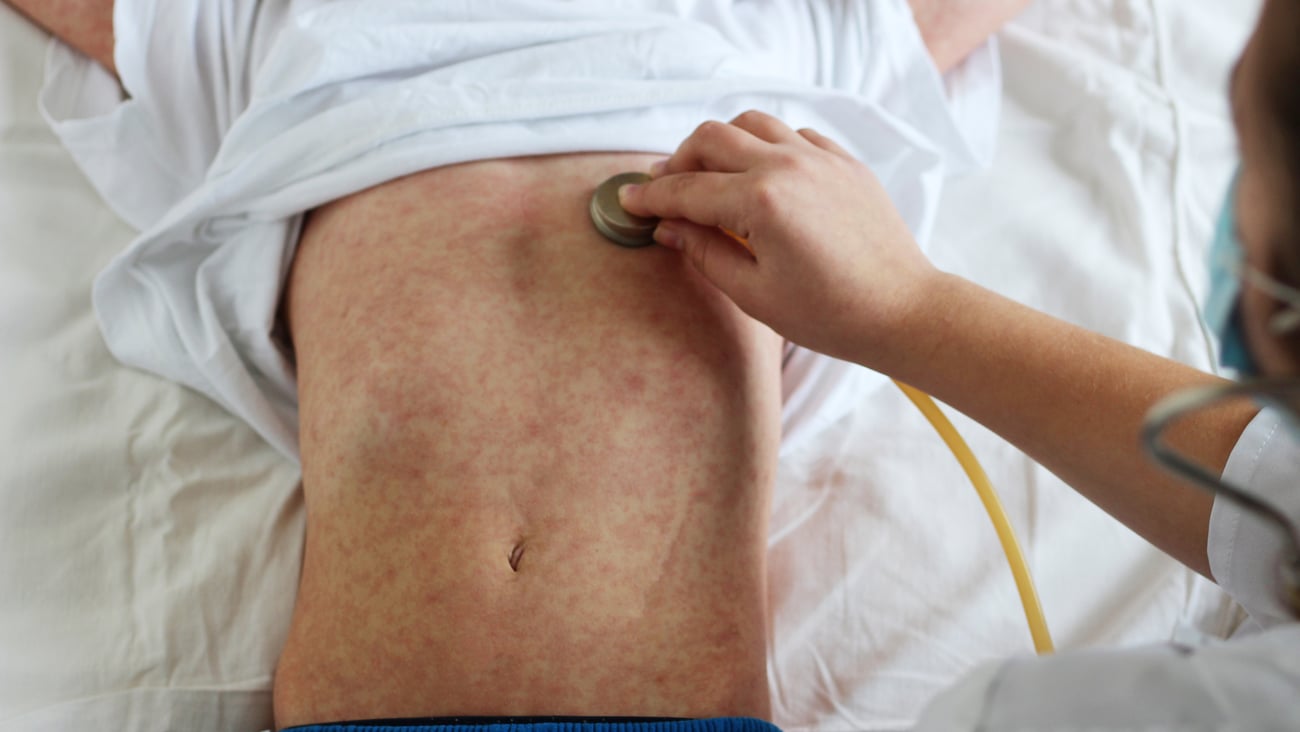 Doctor examining young boy with measles