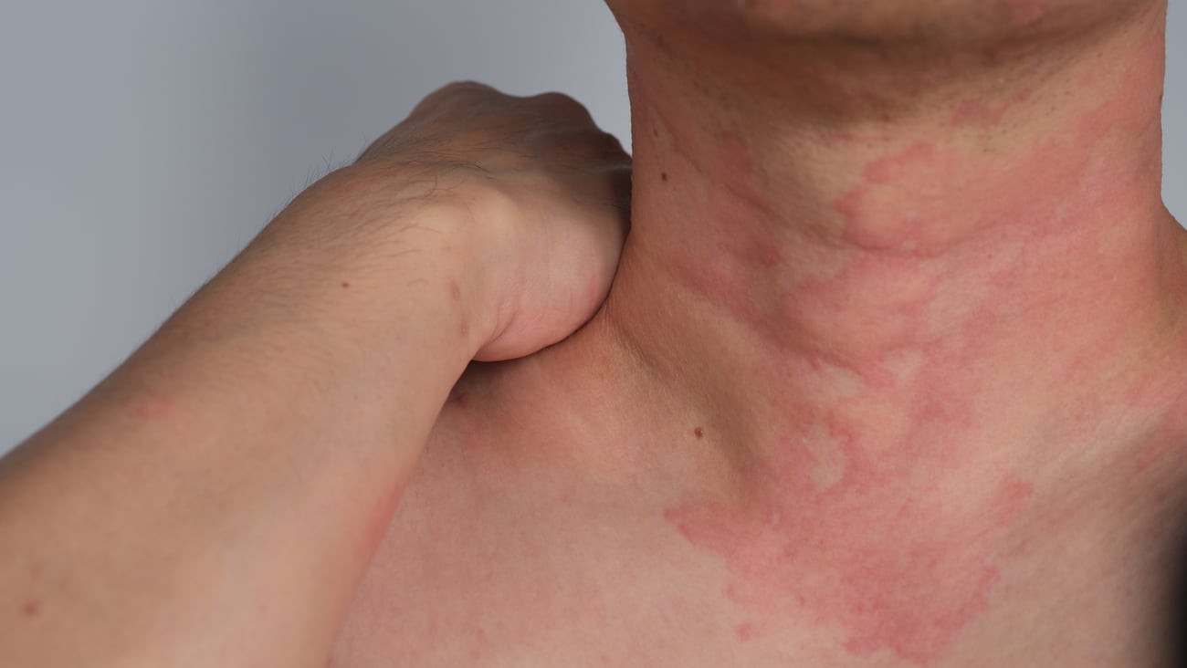 Close up of a man's neck with hives due to an allergic reaction