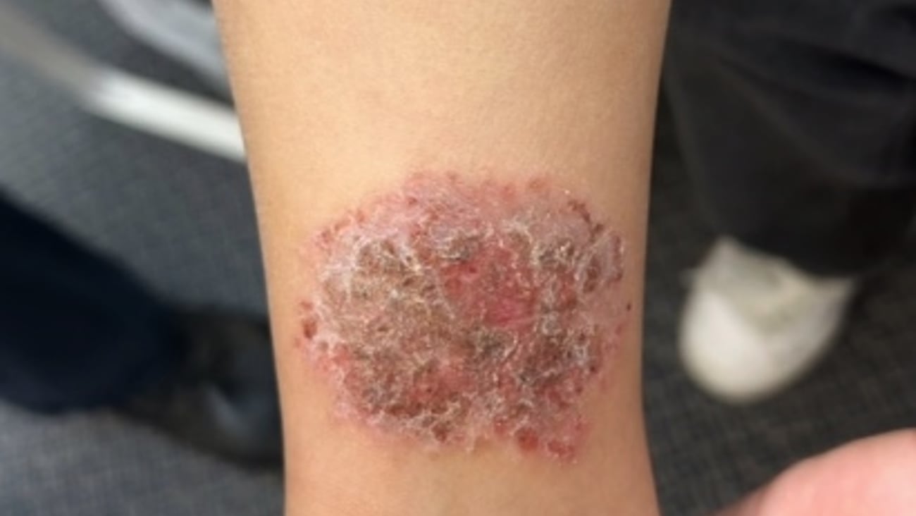 Rash on leg