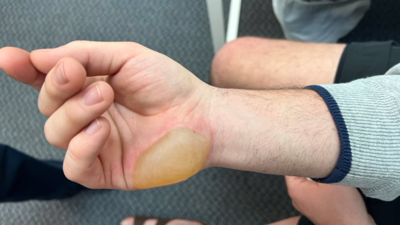 Blister