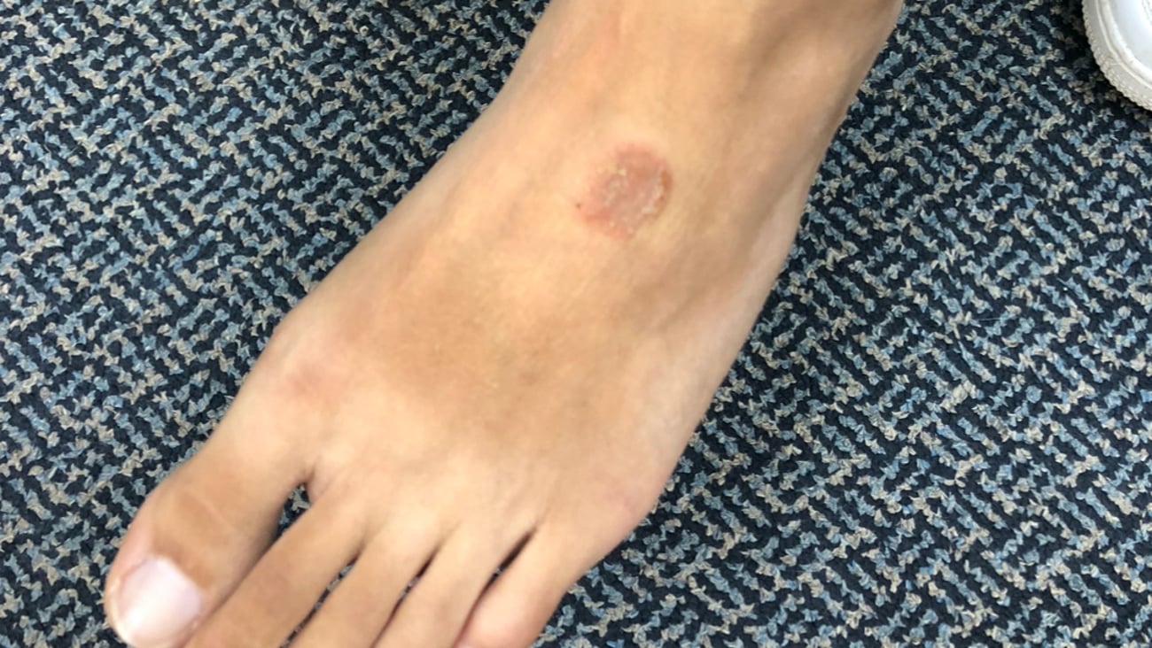 Close up of foot with small circular rash