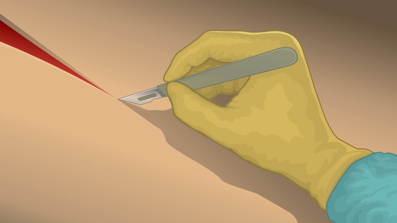 Cartoon close-up of a surgeon's gloved hand cutting flesh in a straight line with a scalpel