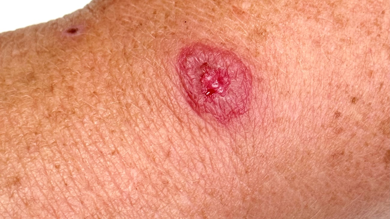 Bullseye rash