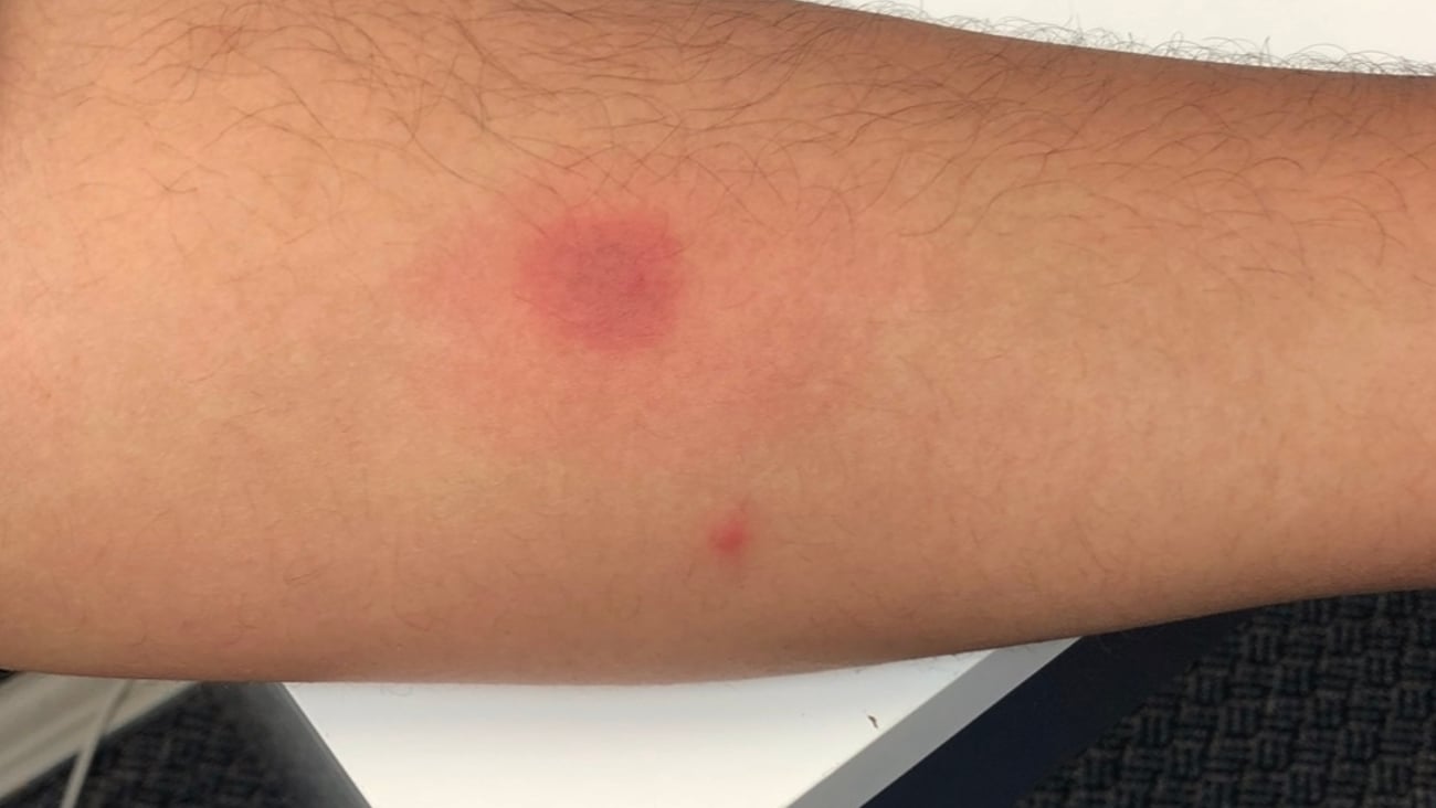 Dot on skin.