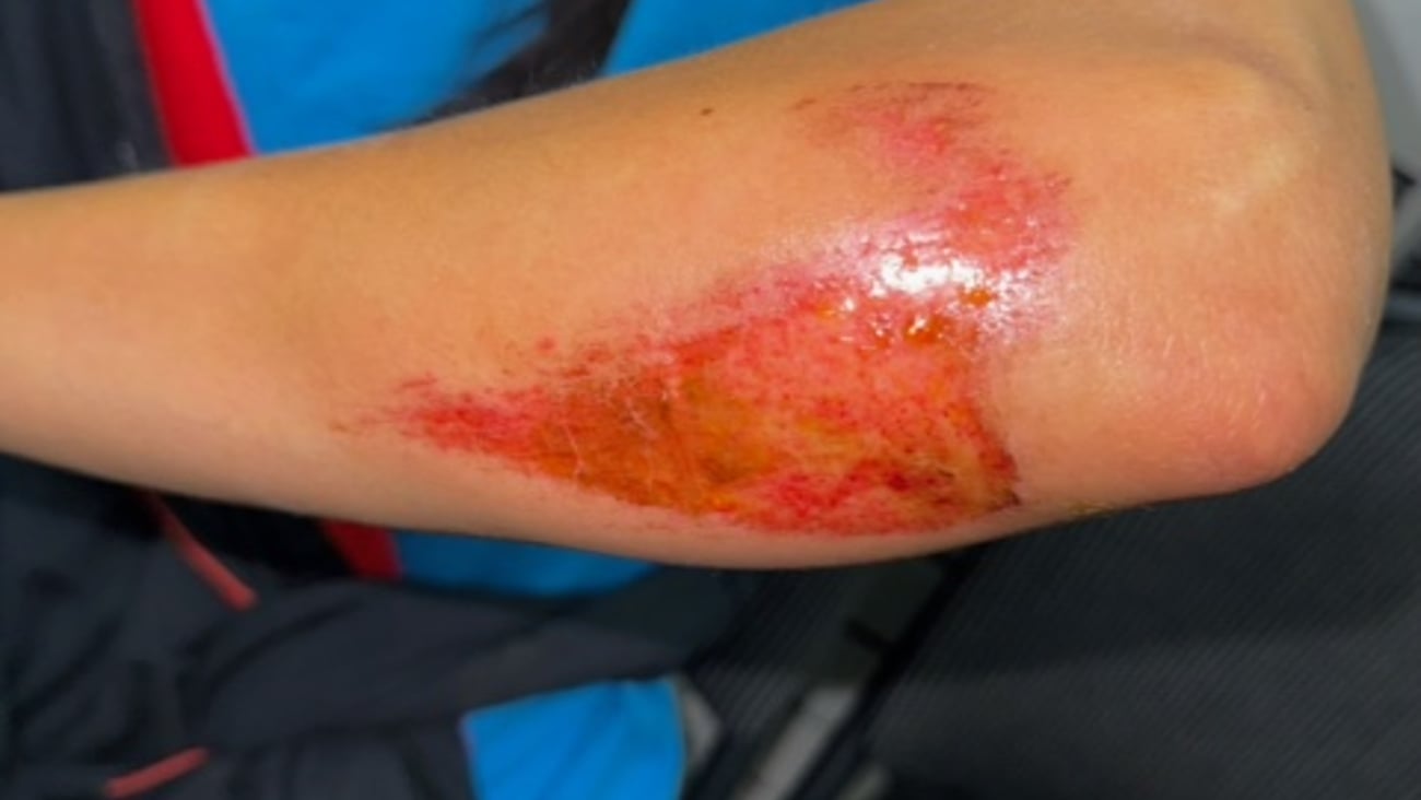 Close up of a man's arm with a large red rash indicating a possible infection