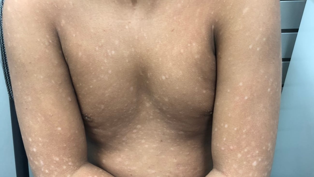 A young boy with a dermatological complaint with white spots on his torso