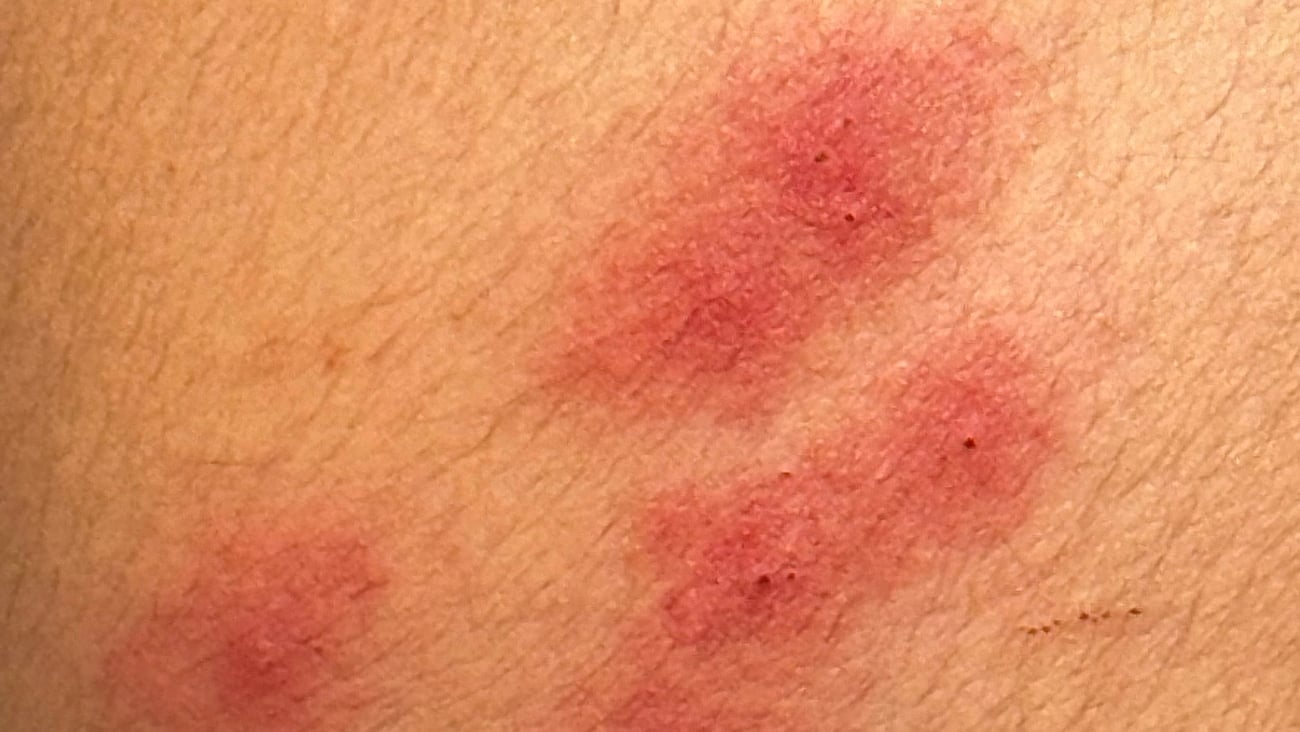Close up of red welts on white skin