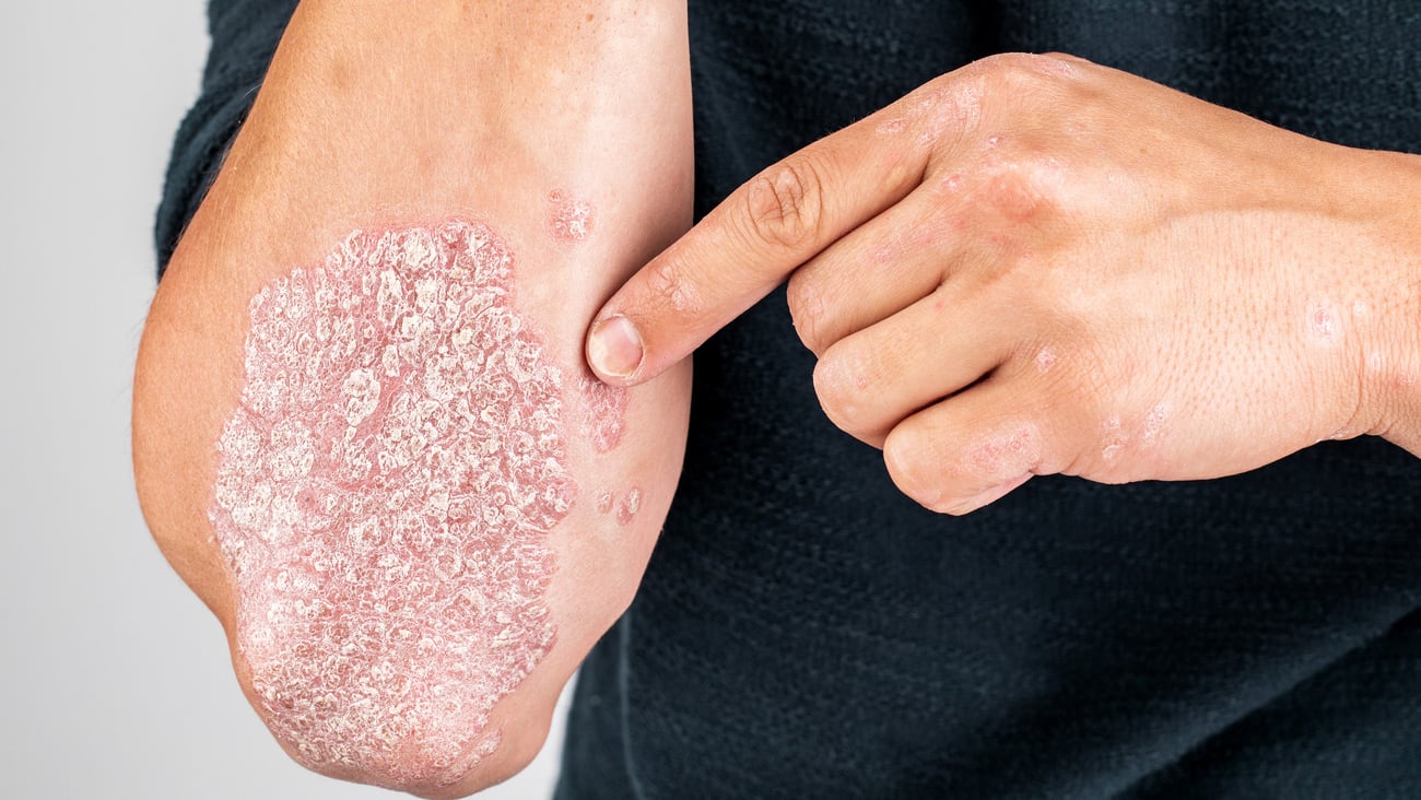 Man with sick hands, dry flaky skin on his hand with vulgar psoriasis, eczema and other skin diseases such as fungus, plaque, rash and blemishes. Autoimmune genetic disease.; Shutterstock ID 1491890960