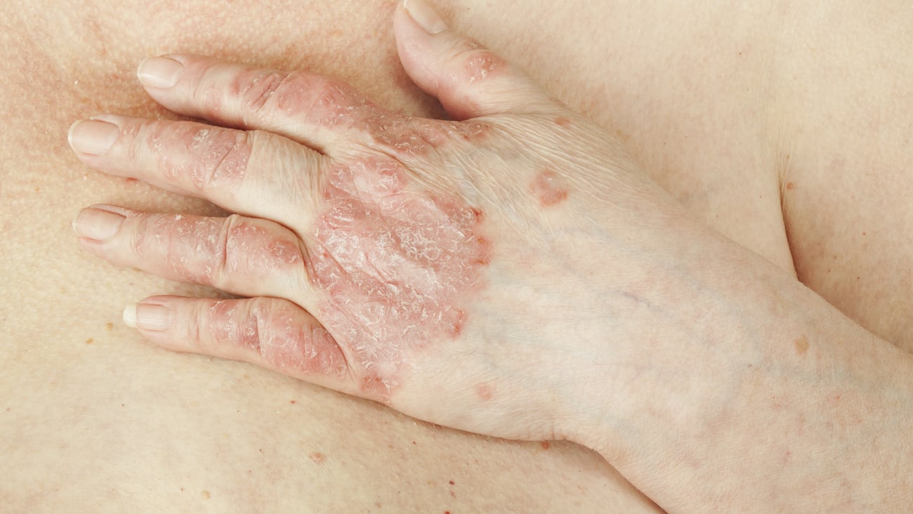 Psoriasis vulgaris is an autoimmune disease that affects the skin, detail photography for mainly medical magazines; Shutterstock ID 114430702