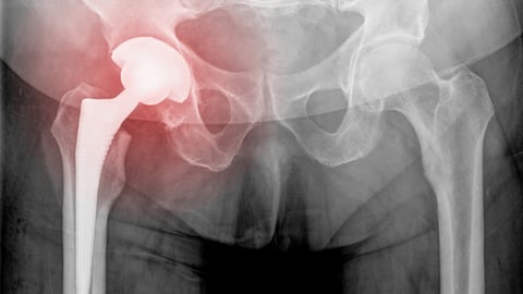 hip x-ray image