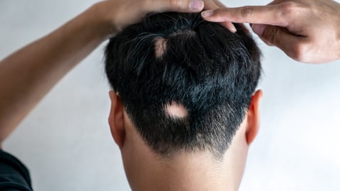 A man with short black hair points to the back of his head where patches of hair are missing.
