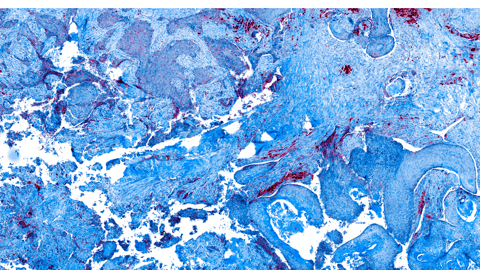 blue scanofcolorectalcancercells