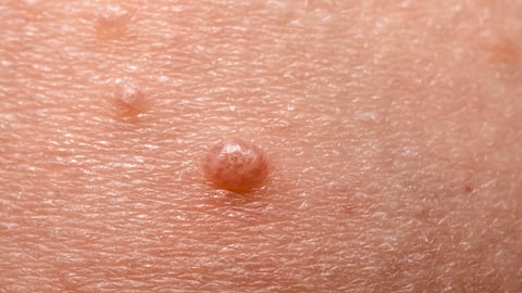 Water wart on skin.