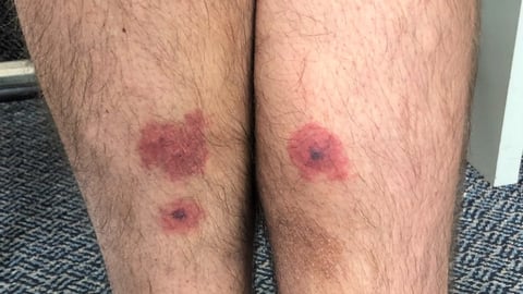 Cropped leg rash