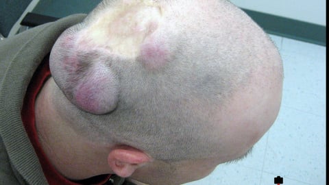 Man with severe sarcoma