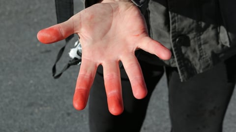 a hand held out to show red fingers with frostbite