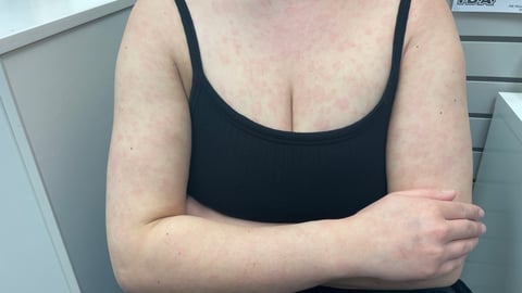 Case report: A COVID rash