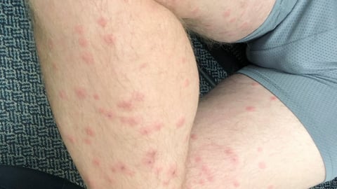 Case report: Oceanic rash